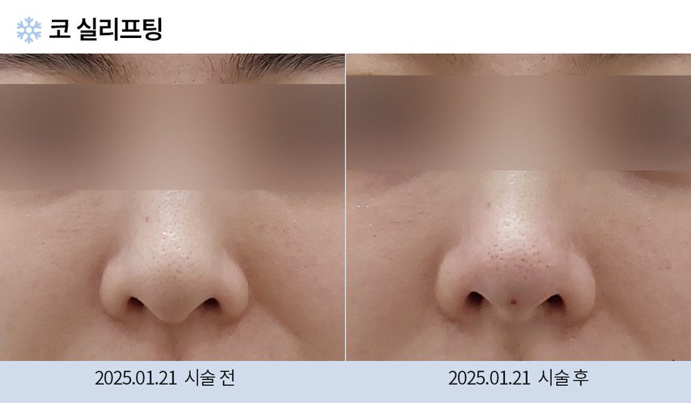 코 실리프팅